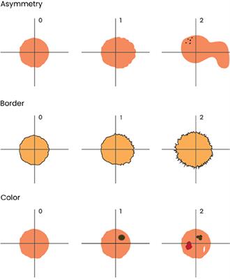 Explainability agreement between dermatologists and five visual explanations techniques in deep neural networks for melanoma AI classification